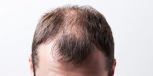 Homme atteint de calvitie - 7 astuces pour arrêter naturellement la perte de cheveux