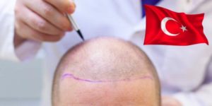 Lire la suite à propos de l’article Greffe de cheveux en Turquie